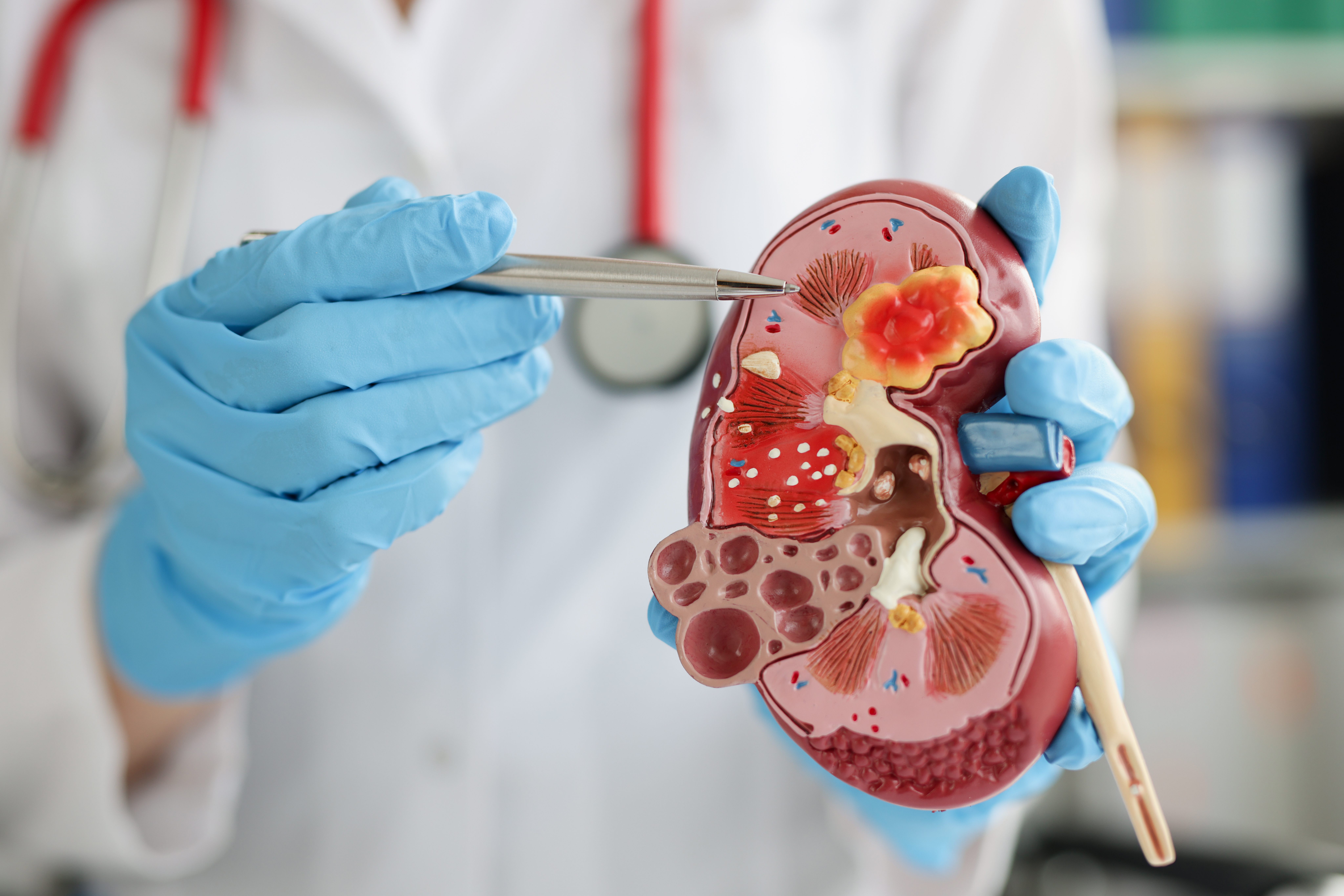 Kidney Cancer research